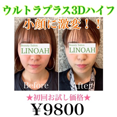 ウルトラプラス3Dハイフ＋首リンパ付き 14800円☆ | ブログ | 脱毛・フェイシャル Beauty Salon LINOAH 大阪梅田店